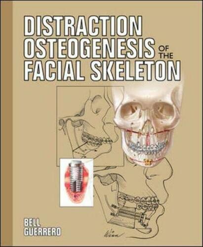 Distraction Osteogenesis Of The Facial Skeleton