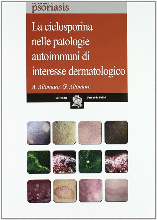 La Ciclosporina Nelle Patologie Autoimmuni Di Interesse Dermatologico Andrea A